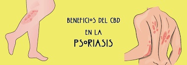 cbd psoriasis