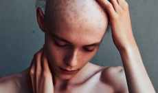 CBD y la alopecia ¿Sirve para algo?